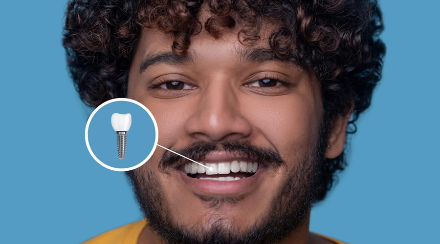 Implantes Dentários